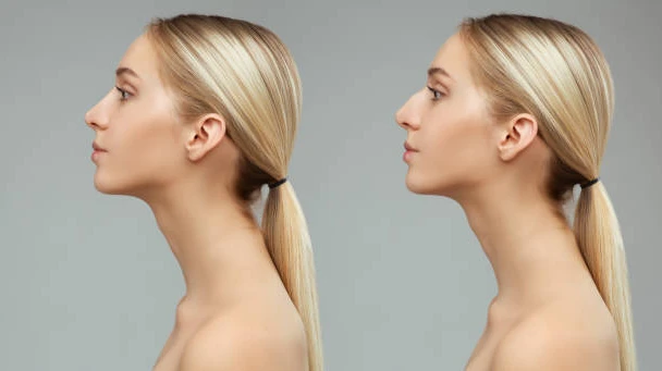 Rhinoplasty Treatment Information in Riyadh