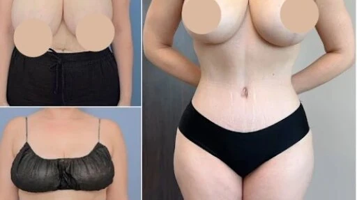 Best Tummy Tuck Surgeon in Dubai for Smooth and Natural-Looking Contours