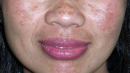 What Is the Melasma Treatment Cost in 2026?