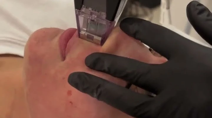 Is Morpheus8 Treatment an Option After Age 30?