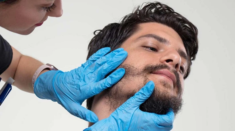 Beard Hair Transplant in Dubai Results Explained