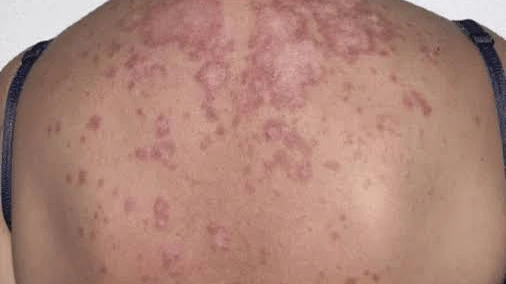 What Are the Benefits of Skin Diseases Treatment Today?