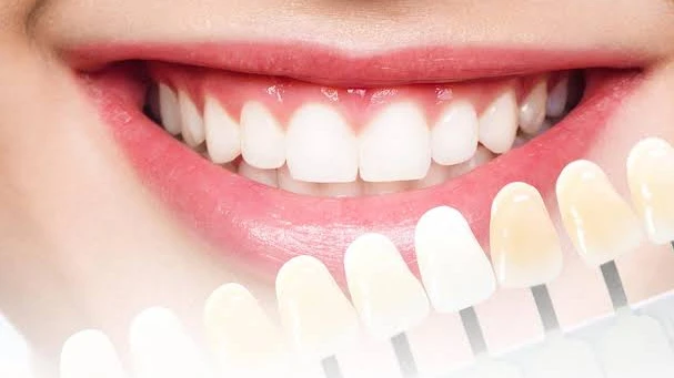 How Do E-Max Veneers Improve Your Smile Aesthetics?