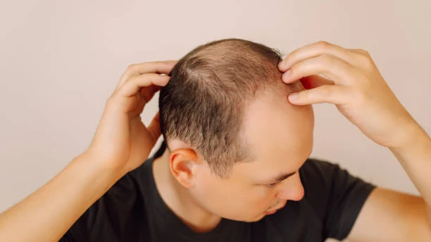 Hair Loss Treatment for Alopecia