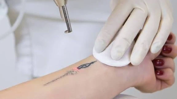 Experience Modern Tattoo Fading with Laser Tattoo Removal