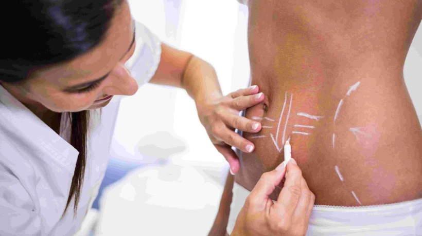 Can Stretch Marks Be Reduced? Understanding Treatment Options