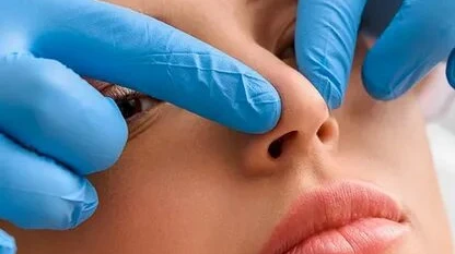 Can Revision Septoplasty Cost More Than the First Procedure?
