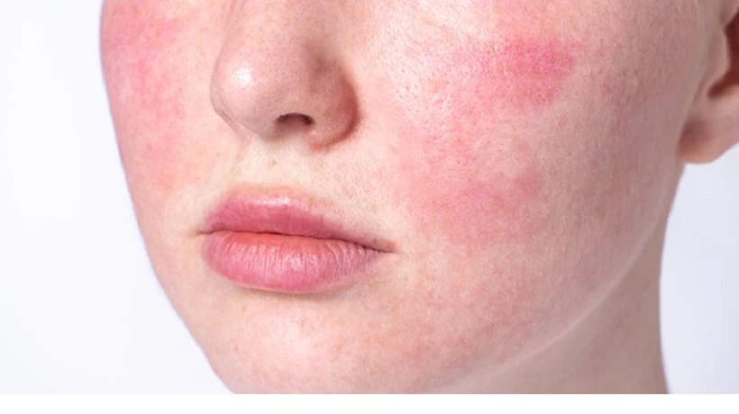 Is Rosacea Treatment permanent?