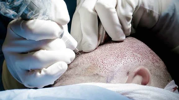 Embrace a Fuller Appearance with Hair Transplant