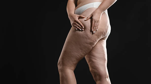 What Are the Possible Risks and Complications of Lipedema Surgery?