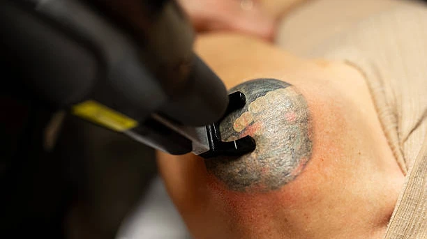 Can Old Tattoos Be Easier to Remove?