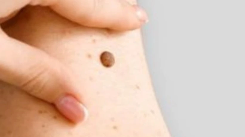 Mole Removal Treatment for Clearer and Smoother-Looking Skin
