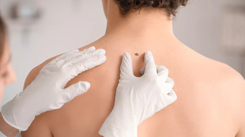 Can Mole Removal Help Reduce the Appearance of Flat Moles?