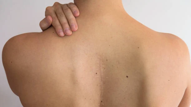Laser Scar Removal in Riyadh: Your Path to Smoother, Confident Skin