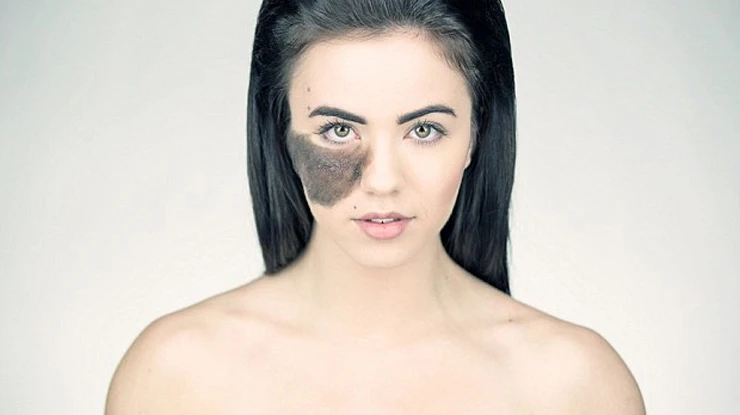 Can Laser Birthmark Removal Cost Differ for Flat Marks?