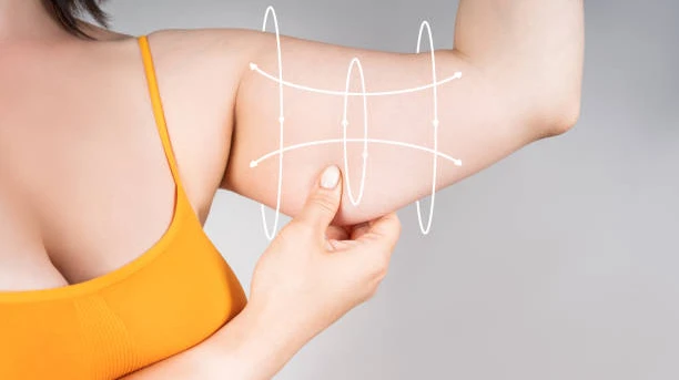 What Happens During an Arm Lift Procedure?