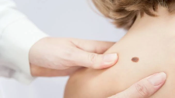 How Does Birthmarks Removal Work?