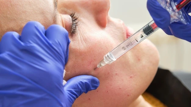 Can Vampire Facial Help Improve the Look of Tired Skin?