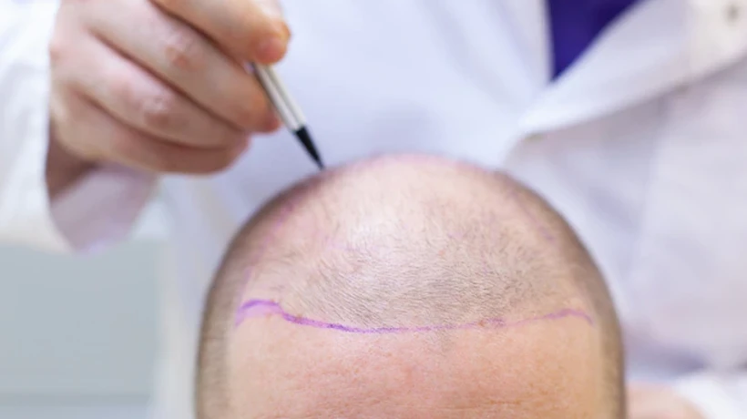 Is there downtime after a hair transplant?