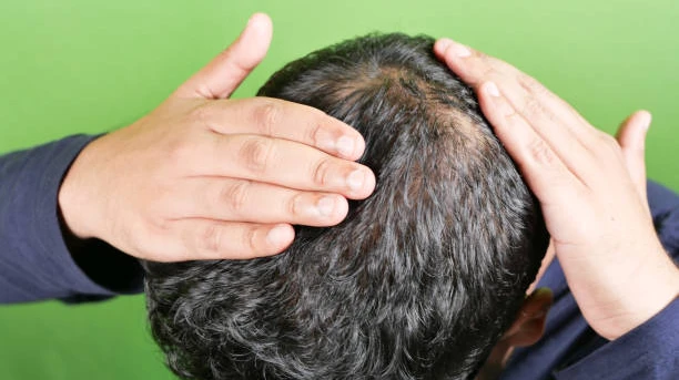 Can PRP Hair Treatment Help Strengthen Weak Hair?