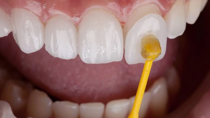 How Much Should You Budget for Teeth Whitening?
