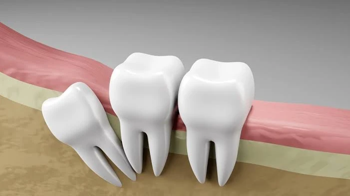 What Are the Signs You Need Wisdom Tooth Extraction?