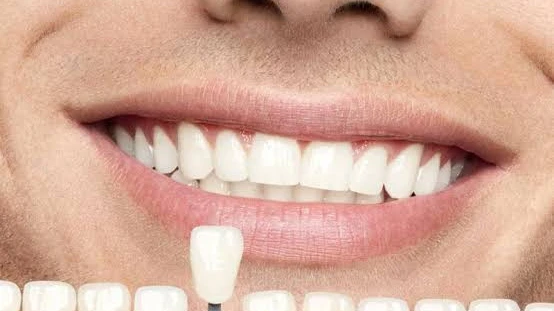 Can Hydrogen Peroxide Teeth Whitening Damage Enamel?