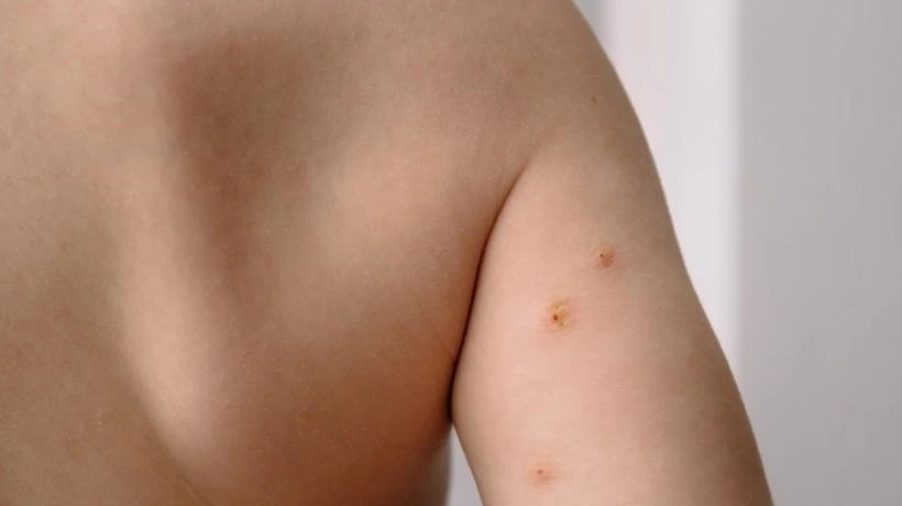 How much does wart removal cost?