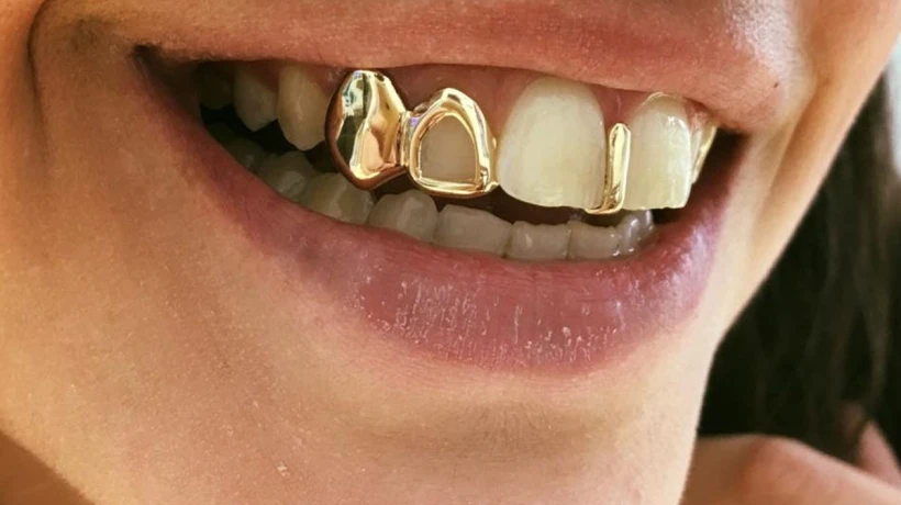 How Long Do Gold Teeth Last With Proper Dental Care?