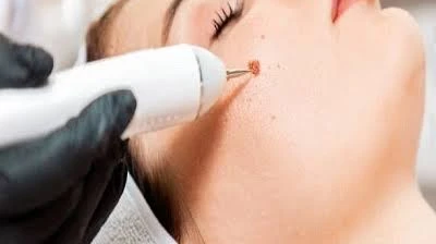 Why Choose a Dermatologist for Skin Lesion Removal