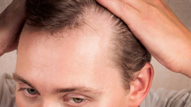 How Do Medical Professionals Evaluate Scalp Health Before PRP Therapy?