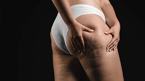 How to Reduce Leg Swelling Caused by Lipedema